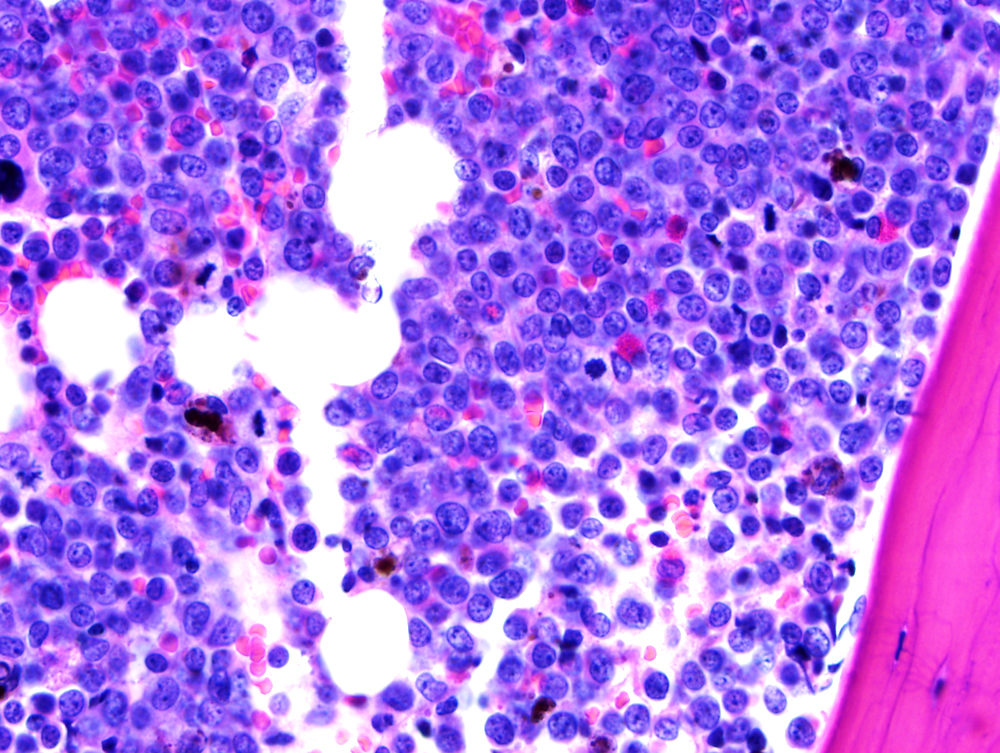 bone marrow biopsy, 2012